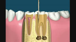طریقه عصب کشی و روکش کردن دندان ها