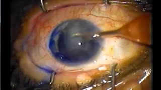 جراحی کاتاراکت