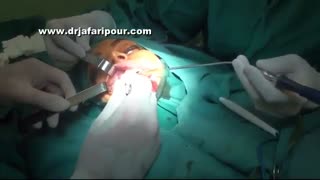 عمل گونه کامپوزیت ونیر