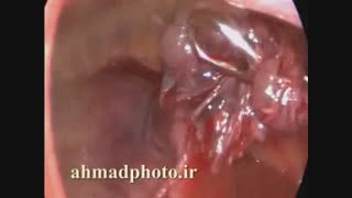 جراحی توراکس ریه