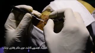 کاشت مو به روش FIT دندان پیش