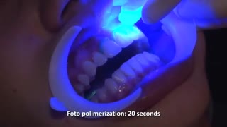 سفید کردن دندان ویزه دانشجویان دندان پزشکی