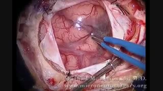 Brain Surgery ; جراحی تومور مغز!
