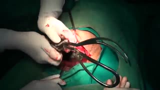 عمل سزارین; Cesarean section!