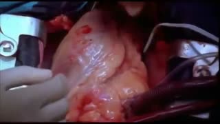 open heart surgery- Heart Transplant پیوند قلب!