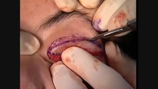 Blepharoplasty ; عمل بزرگ کردن چشم!