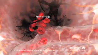 سکته هموراژیک