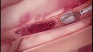 پیروزی انسان بر لخته شدن خون در رگ