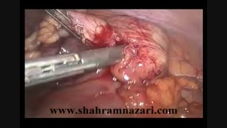 آپاندکتومی لاپاروسکوپیک در درمان آپاندسیت حاد توسط دکتر شهرام نظری فوق تخصص جراحی های لاپاروسکوپی پیشرفته