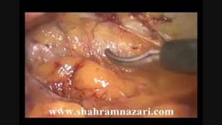 هرنیورافی لاپاروسکوپیک در زن