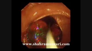 جراحی داخل روده ای با کمک کلونوسکوپ