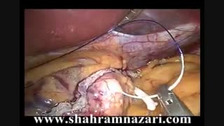 اسلیو گاسترکتومی (اسلیو معده)