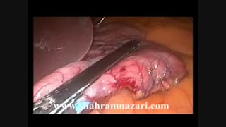 اسلیو گاسترکتومی (اسلیو معده) توسط دکتر شهرام نظری بلیچینگ