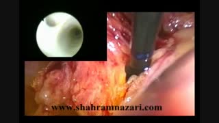 جراحی کله سیستکتومی لاپاروسکوپیک با اکسپلور کلدوک حین عمل وکلدوکوسکوپی و کارگذاری T-Tube