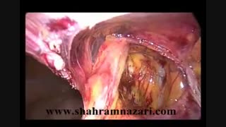 ترمیم لاپاروسکوپیک هرنی عود کرده در زن