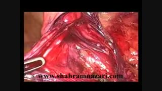 آزاد کردن ساک فتق در جراحی لاپاروسکوپیک هرنی کشاله ران