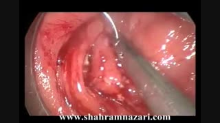 جراحی آندوسکوپیک اینترالومینال پیشرفته بروش TEM