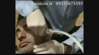 دستگاه-میکرودرم-ابریژن ماموپلاستی