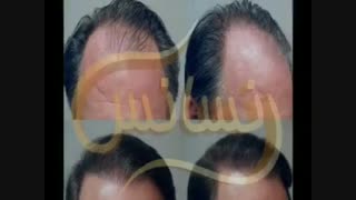 کاشت مو به روش SUT مرکز تخصصی مو رنسانس