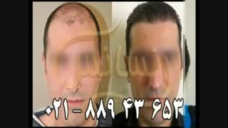کاشت مو به روش SUT مرکز تخصصی مو رنسانس