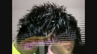 کاشت مو به روش SUT مرکز تخصصی مو رنسانس