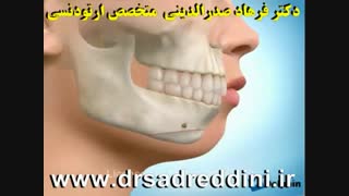 ارتودنسی پر کردن دندان