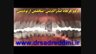 ارتودنسی لیپوماتیک