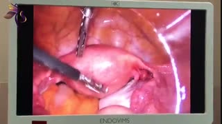 لاپاراسکوپی کیست تخمدان