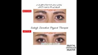 فیلم فیزیوتراپی فلج بلز
