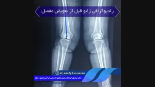 خانم ۶۰ ساله با زانوی ضربدری