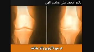 آرتروز زانو
