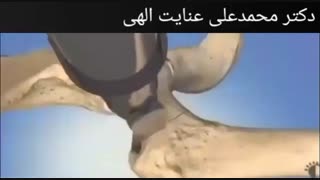 تعویض مفصل لگن