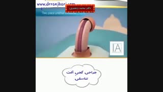 انیمیشن نحوه جراحی کجی آلت تناسلی | دکتر محمد رنجبری