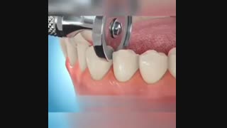 نحوه مرتب سازی دندان توسط ارتودنسی