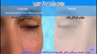 بلفاروپلاستی (جراحی زیبایی) پلک پایین -مرکز چشم پزشکی دکتر علیرضا نادری
