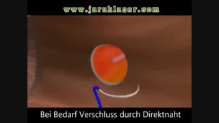 درمان فیستول با لیزر- کلینیک مهنا