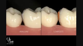 پرکردن دندان با مواد سفید خوبه یا سیاه