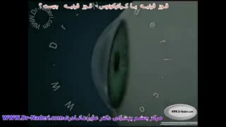 قوز قرنیه یا کراتوکونوس - مرکز چشم پزشکی دکتر علیرضا نادری