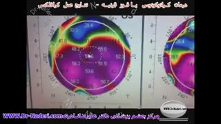 نتایج عمل کرافلکس - مرکز چشم پزشکی دکتر علیرضا نادری