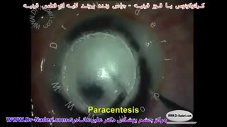 جراحی پیوند لایه ای قرنیه در قوز قرنیه - مرکز چشم پزشکی دکتر علیرضا نادری