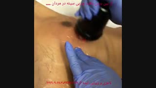 کوچک کردن سینه ی آقایان با ژنیکوماستی