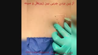 مزوتراپی زیر بغل