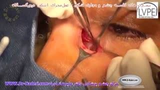 عمل جراحی مجرای اشکی در بزرگسالان_چشم پزشکی دکتر نادری
