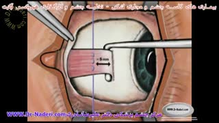 تخلیه چشم و کارگذاری هیدروکسی آپاتیت- مرکز چشم پزشکی دکتر نادری