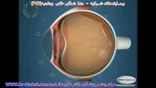 جدا شدگی خلفی زجاجیه (PVD)- مرکز چشم دکتر علیرضا نادری