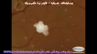 مگس پران یا فلوتر -مرکز چشم پزشکی دکتر علیرضا نادری