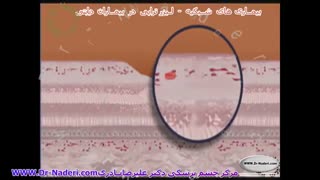 لیزر تراپی در بیماران دیابتی -مرکزچشم پزشکی دکترعلیرضا نادری