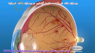 لیزر تراپی در بیماران دیابتی -مرکزچشم پزشکی دکترعلیرضا نادری