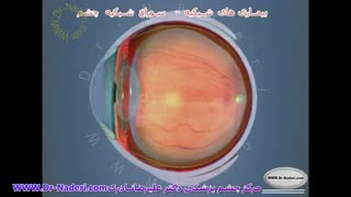 سوراخ شبکیه - مرکز چشم پزشکی دکتر علیرضا نادری