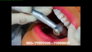 ونیر کامپوزیت دندان برای زیبایی دندان